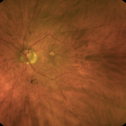 Early extrafoveal unifocal hypopigmented lesion. Image courtesy of Dr. Julie Rodman.